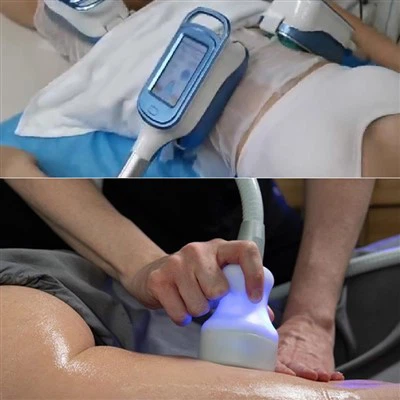 Coolsculpting-koneen hinta