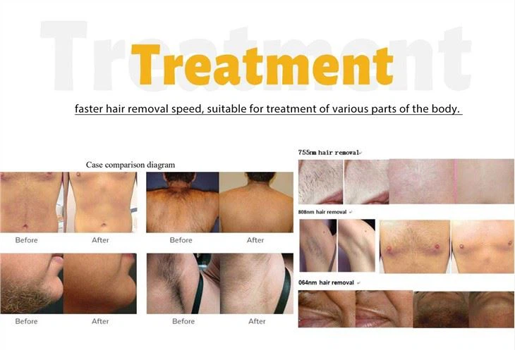 Alexandrite Laser Hair Removal Machine